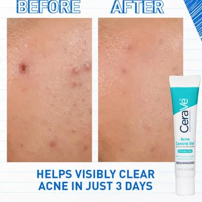 CeraVe Acne Control Gel,2%Salicylic Acid Treatment With Glycolic Acid + Lactic